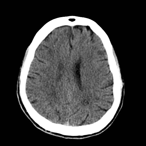 File:Artery of Percheron infarct (Radiopaedia 48088-52893 Axial non-contrast 28).jpg