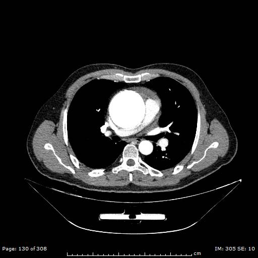 Ascending aortic aneurysm (Radiopaedia 50086-55404 A 34).jpg