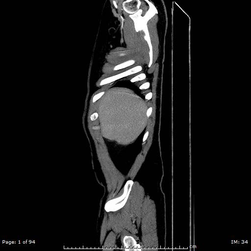 File:Ascending aortic aneurysm (Radiopaedia 50086-55404 C 1).jpg
