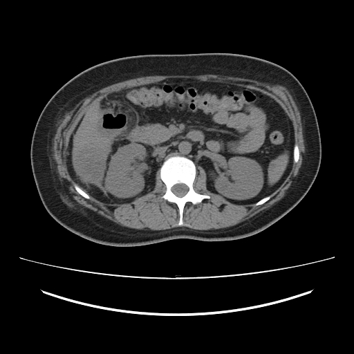 Ascending retrocecal appendicitis with liver abscesses (Radiopaedia 60066-67615 Axial non-contrast 35).jpg