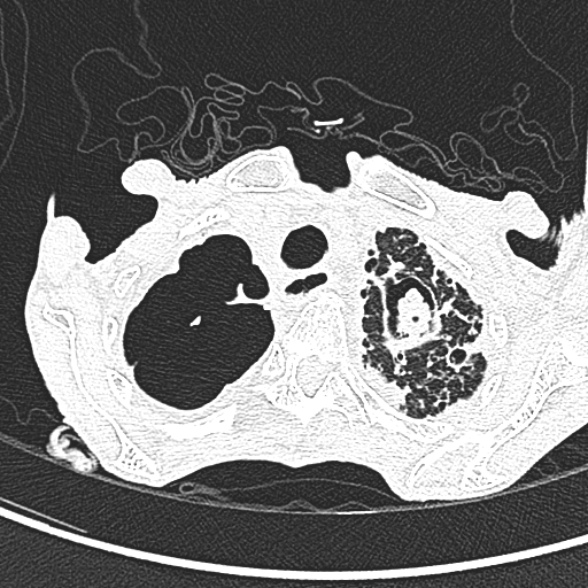 Aspergilloma- with Monod sign (Radiopaedia 44737-48532 Axial lung window 46).jpg
