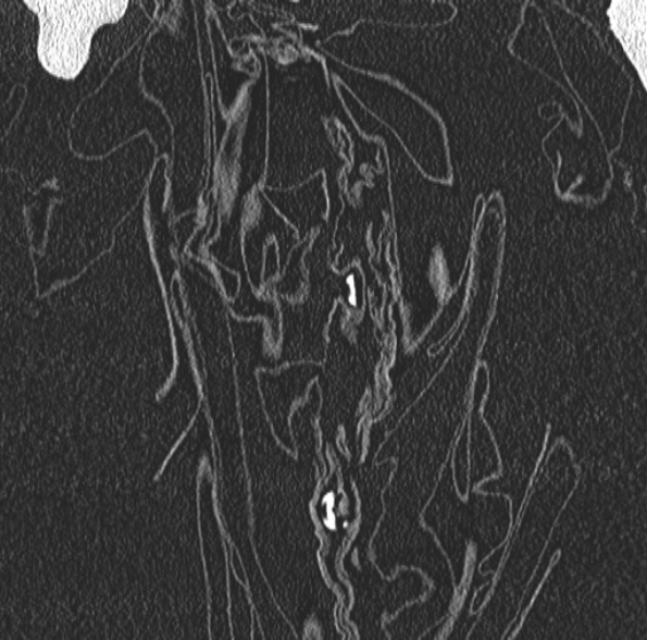 Aspergilloma- with Monod sign (Radiopaedia 44737-48532 Coronal lung window 88).jpg