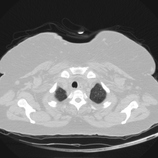 Aspergilloma (Radiopaedia 39611-41932 Axial lung window 5).jpg