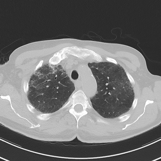 Aspergilloma on background pulmonary fibrosis (Radiopaedia 60942-68757 A 15).jpg