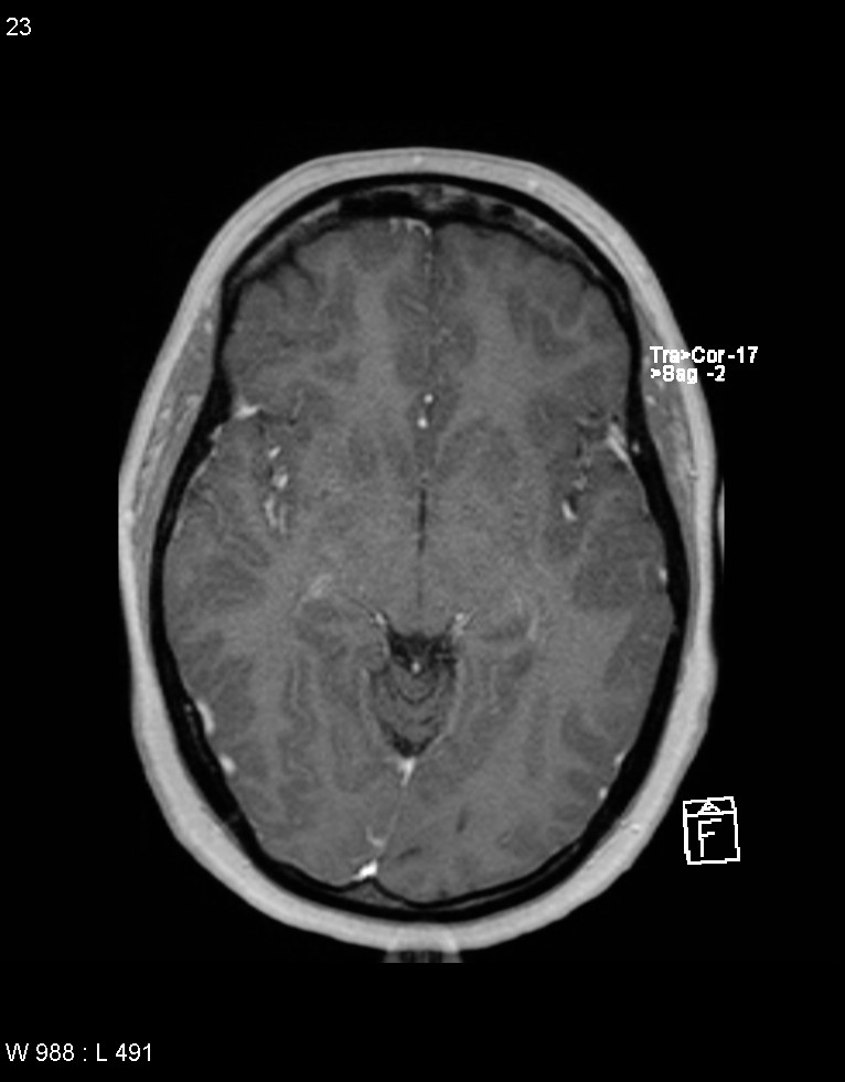 Astroblastoma (Radiopaedia 39792-42217 Axial T1 C+ 22).jpg