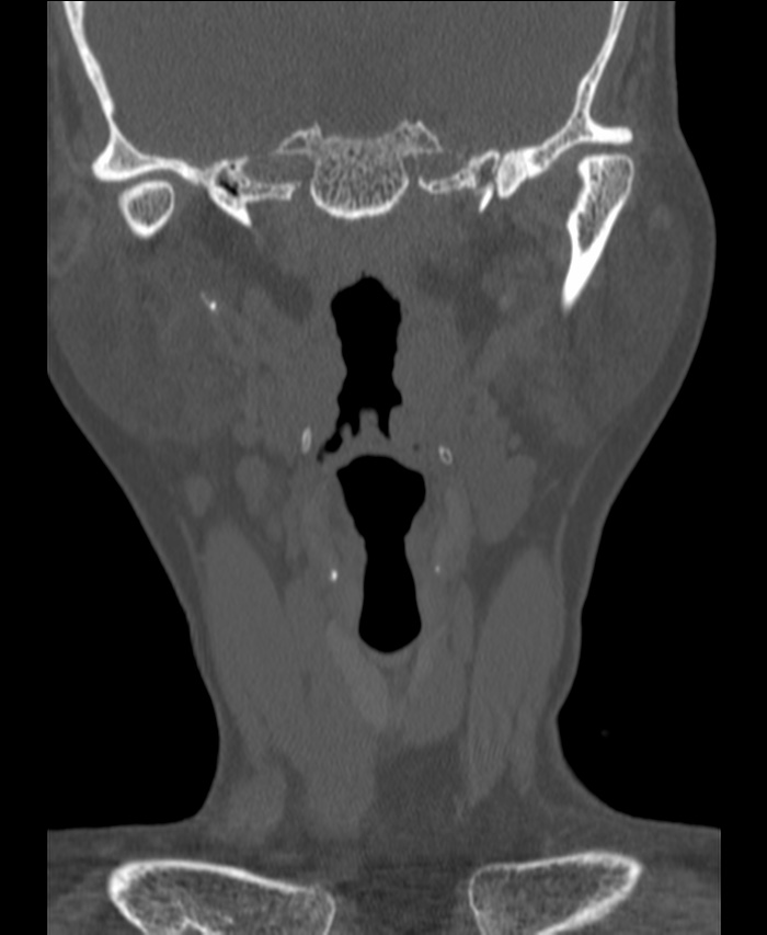Atlanto-occipital assimilation with basilar invagination (Radiopaedia 70122-80188 Coronal bone window 10).jpg