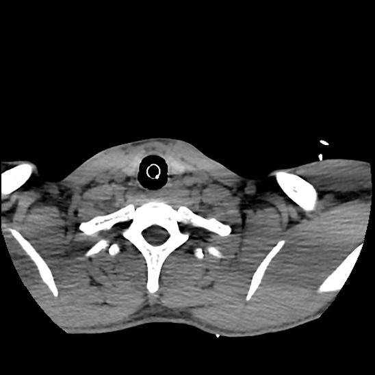 File:Atlanto-occipital dissociation (Traynelis type 1), C2 teardrop fracture, C6-7 facet joint dislocation (Radiopaedia 87655-104061 Axial non-contrast 77).jpg