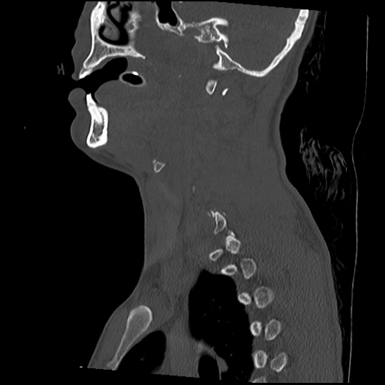 Atlanto-occipital dissociation (Traynelis type 1), C2 teardrop fracture, C6-7 facet joint dislocation (Radiopaedia 87655-104061 Sagittal bone window 23).jpg