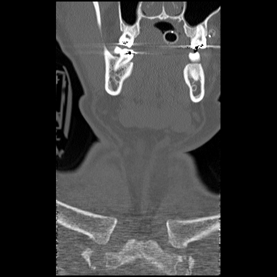 Atlanto-occipital dissociation injury (Radiopaedia 29274-29698 Coronal bone window 58).png