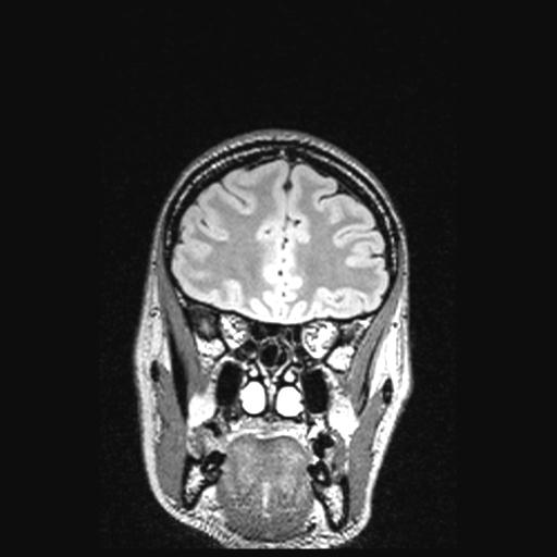 Atretic encephalocoele with inferior vermis hypoplasia (Radiopaedia 30443-31108 Coronal FLAIR 137).jpg