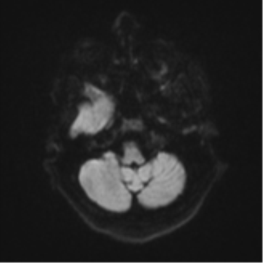 Atypical meningioma (WHO Grade II) (Radiopaedia 54742-60979 Axial DWI 34).png