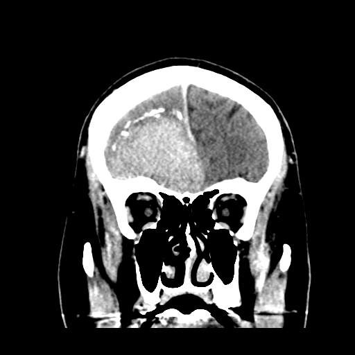 Atypical meningioma (WHO grade II) with brain invasion (Radiopaedia 57767-64728 Coronal C+ 16).png
