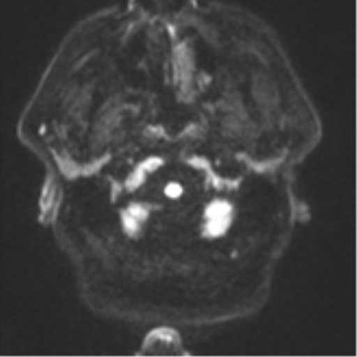 File:Atypical meningioma (WHO grade II) with brain invasion (Radiopaedia 57767-64729 Axial DWI 32).png