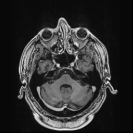 Atypical meningioma (WHO grade II) with brain invasion (Radiopaedia 57767-64729 Axial T1 C+ 11).png