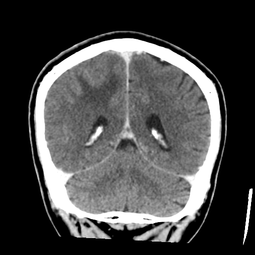 Atypical meningioma with skull invasion (Radiopaedia 34357-35649 Coronal C+ delayed 43).png