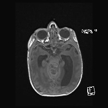 Atypical teratoid rhabdoid tumor (prenatal US and neonatal MRI) (Radiopaedia 59091-66388 Axial T1 24).jpg