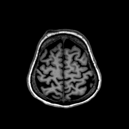 Autoimmune limbic encephalitis (Radiopaedia 30363-31005 T1 Axial 1mm 126).jpg