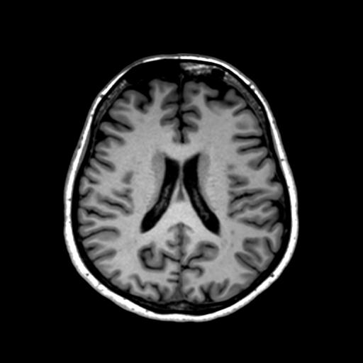 Autoimmune limbic encephalitis (Radiopaedia 30363-31005 T1 Axial 1mm 93).jpg