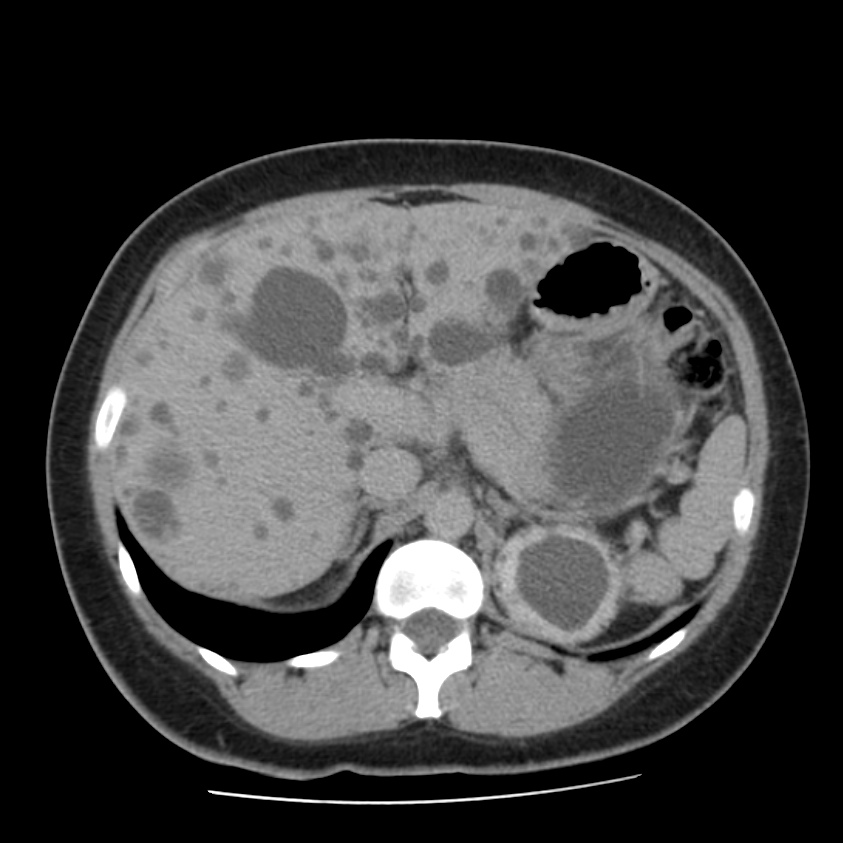 Autosomal dominant polycystic kidney disease (Radiopaedia 23061-23093 C+ delayed 19).jpg