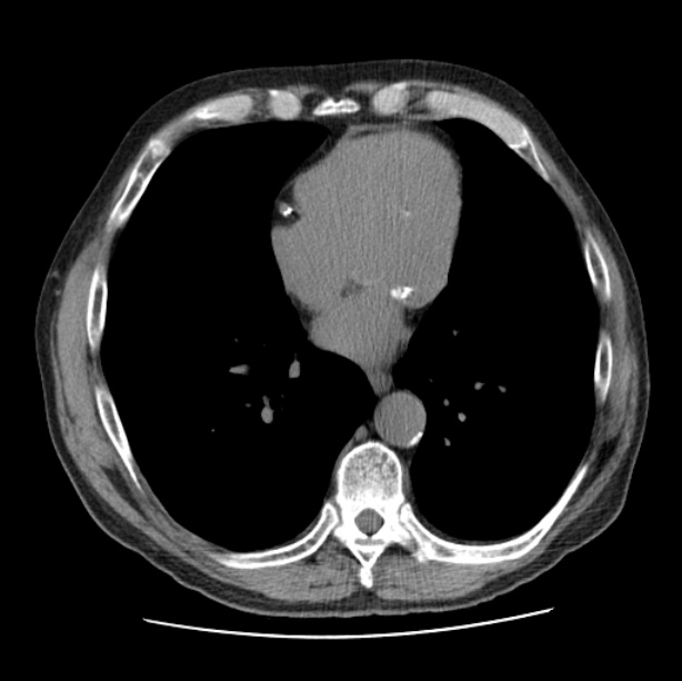 Autosomal dominant polycystic kidney disease (Radiopaedia 27851-28094 Axial non-contrast 37).jpg