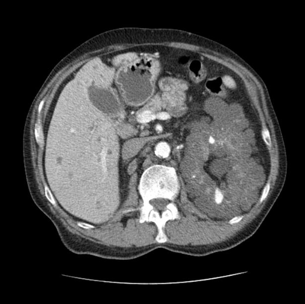 Autosomal dominant polycystic kidney disease (Radiopaedia 27851-28094 B 66).jpg