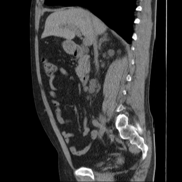 Autosomal dominant polycystic kidney disease (Radiopaedia 36539-38101 D 36).jpg