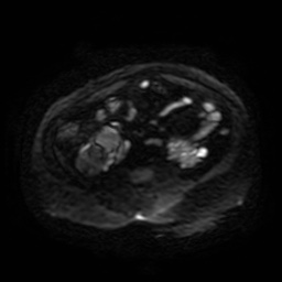 Autosomal dominant polycystic kidney disease (Radiopaedia 50259-55611 Axial DWI 68).jpg