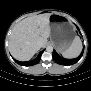 Autosomal dominant polycystic kidney disease (Radiopaedia 66349-75582 B 16).jpg