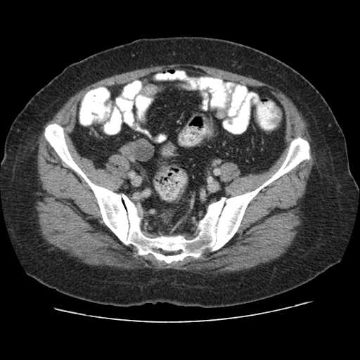 Autosomal dominant polycystic kidney disease with hepatic involvement (Radiopaedia 32693-33662 B 63).jpg