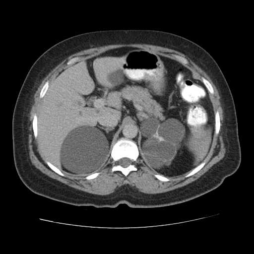 File:Autosomal dominant polycystic kidney disease with hepatic involvement (Radiopaedia 32693-33662 C 21).jpg