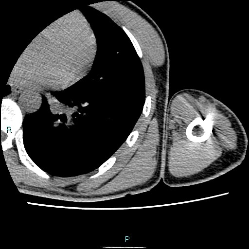 File:Avascular necrosis after fracture dislocations of the proximal humerus (Radiopaedia 88078-104653 D 89).jpg