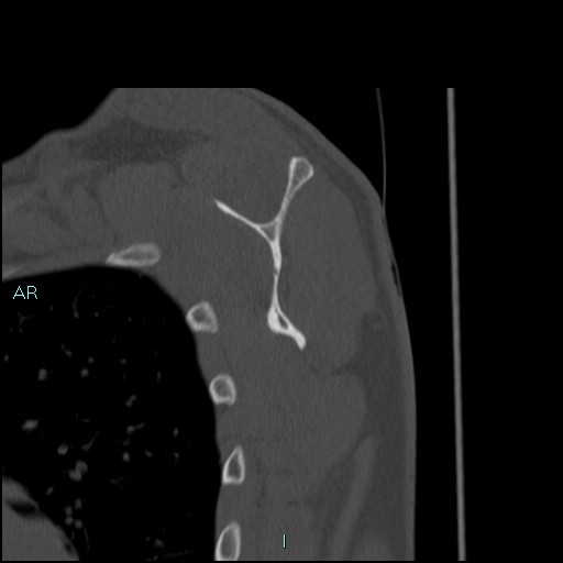 Avascular necrosis after fracture dislocations of the proximal humerus (Radiopaedia 88078-104653 Sagittal bone window 53).jpg
