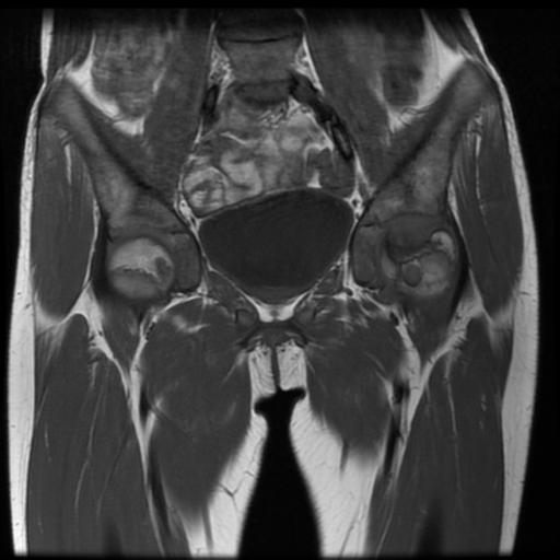 File:Avascular necrosis of the hip (Radiopaedia 29563-30067 Coronal T1 5).jpg