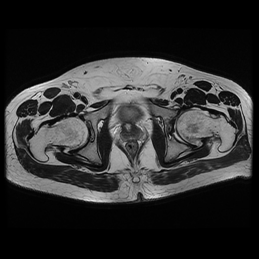 File:Avascular necrosis of the hip (Radiopaedia 61503-69465 T2 19).jpg