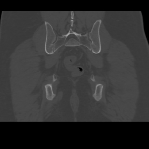 File:Avascular necrosis of the hip (Radiopaedia 61503-69467 Coronal bone window 33).jpg