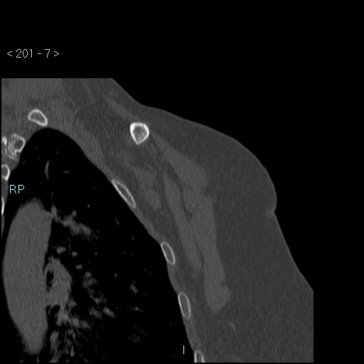 Avascular necrosis of the shoulder - Cruess stage I (Radiopaedia 77674-89887 Coronal bone window 6).jpg