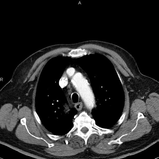 File:Azygos continuation of the inferior vena cava (Radiopaedia 18537-18404 C+ arterial phase 16).jpg