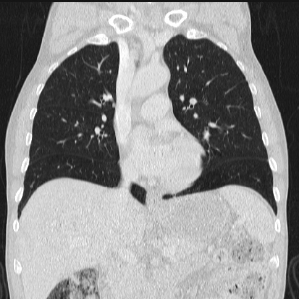 Azygos lobe (Radiopaedia 38259-40275 Coronal lung window 36).jpg