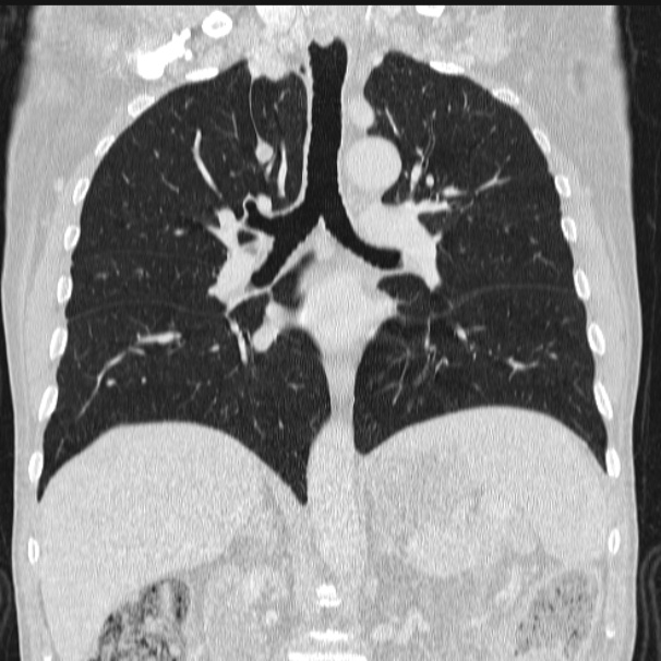 Azygos lobe (Radiopaedia 38259-40275 Coronal lung window 45).jpg