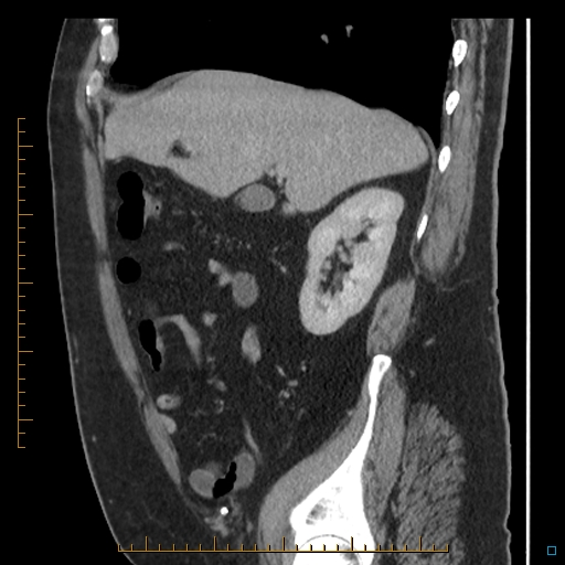 File:Bariatric balloon causing gastric outlet obstruction (Radiopaedia 54449-60672 C 58).jpg