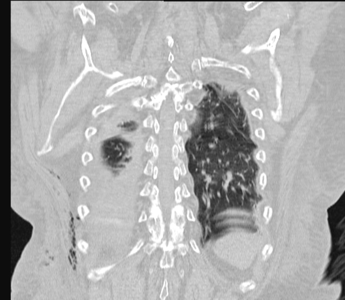 Barotrauma due to mechanical ventilation (Radiopaedia 28079-28336 Coronal lung window 76).jpg