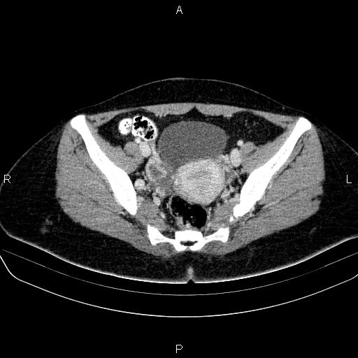 File:Bartholin gland cyst (Radiopaedia 62635-70930 Axial Post contrast 39).jpg
