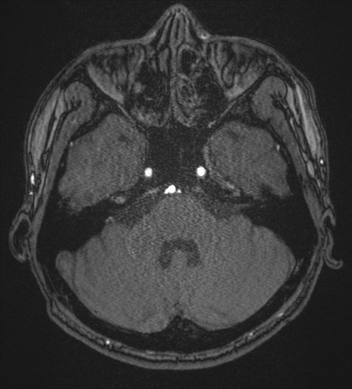 Basal ganglia subacute infarct (Radiopaedia 80201-93521 Axial MRA 18).png