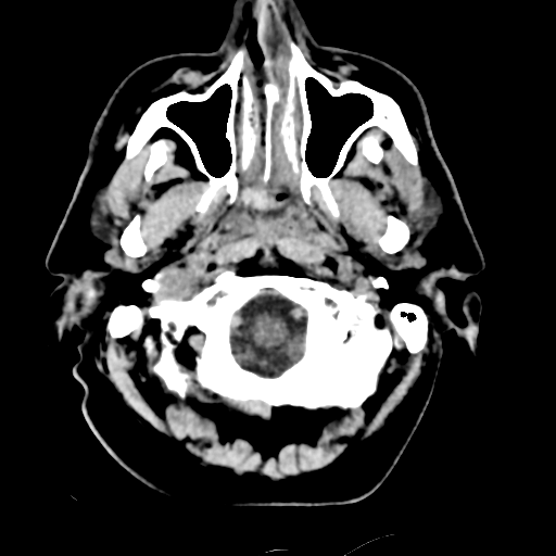 File:Basilar artery occlusion (Radiopaedia 33570-34659 Axial non-contrast 6).png