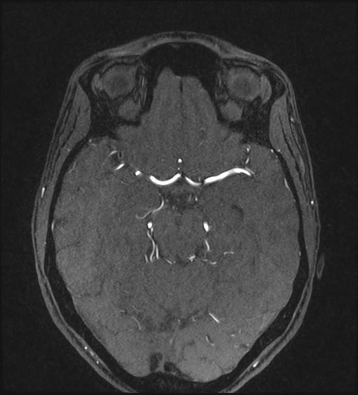 Basilar artery perforator aneurysm (Radiopaedia 82455-97733 Axial MRA 103).jpg