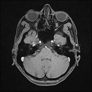 Basilar artery perforator aneurysm (Radiopaedia 82455-97733 Axial T1 fat sat 34).jpg