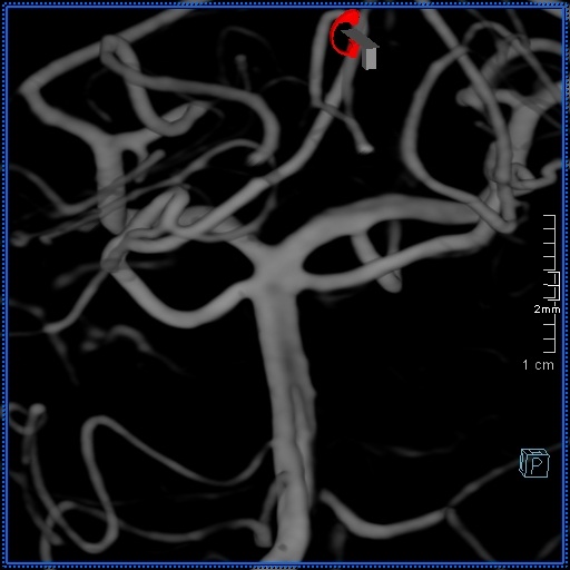 Basilar artery perforator aneurysm (Radiopaedia 82455-99524 3D Left VA 2).jpg