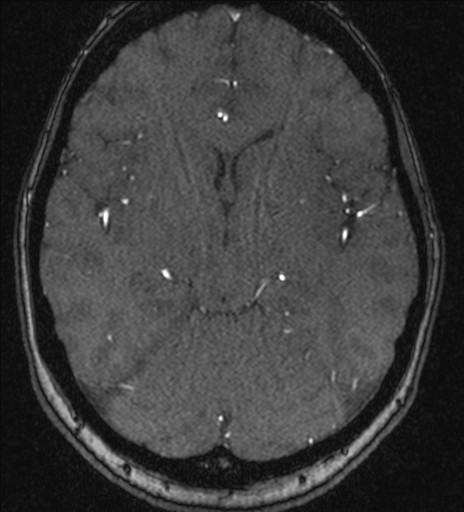 Basilar tip aneurysm (Radiopaedia 26504-26632 MRA 108).jpg