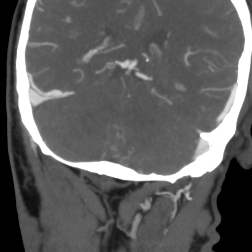 File:Basilar tip thrombus with endovascular clot retrieval (Radiopaedia 46320-50729 A 24).png