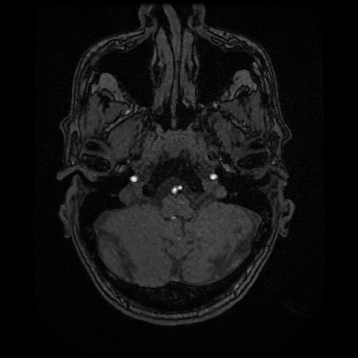 Basilar top and left middle cerebral artery aneurysm (Radiopaedia 61965-70031 Axial MRA 18).jpg